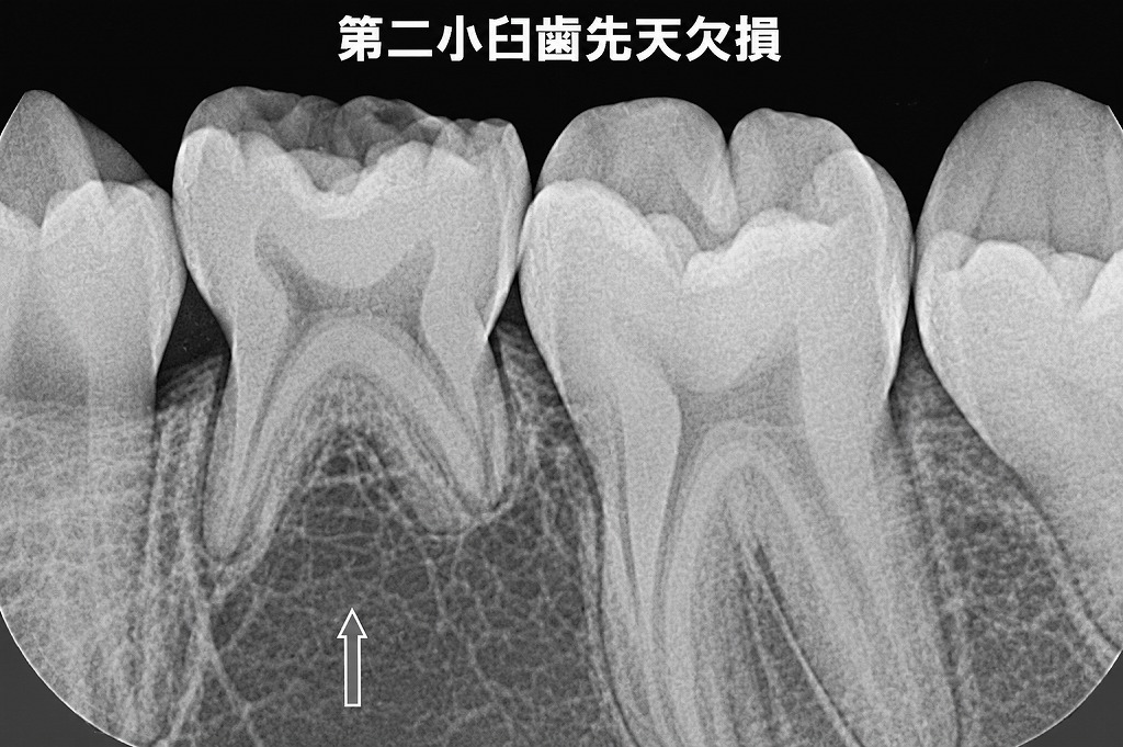 本来あるはずの永久歯（第二小臼歯）が確認できません。