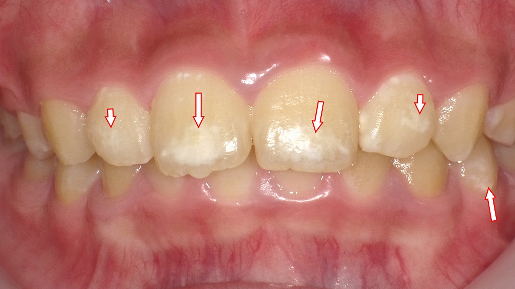 8歳児の前歯に見られるホワイトスポット（白斑）