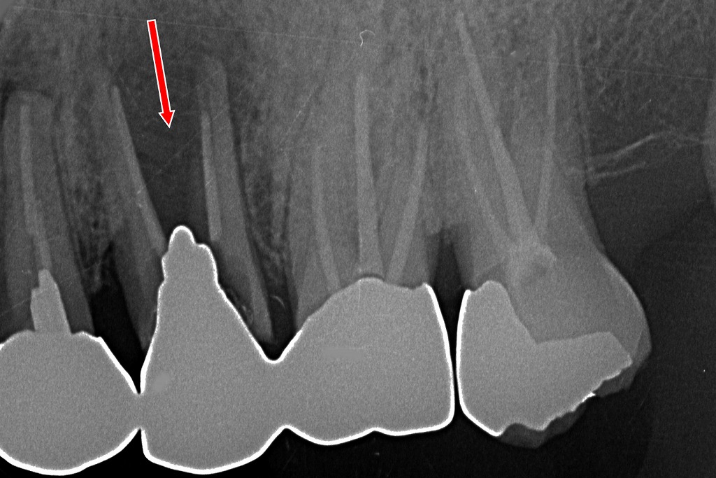 赤矢印部：メタルコア装着歯に生じた上顎5番の歯根破折を示す透過像。