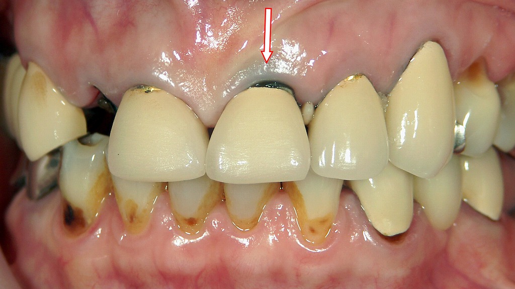 メタルタトゥーの症例：術前
