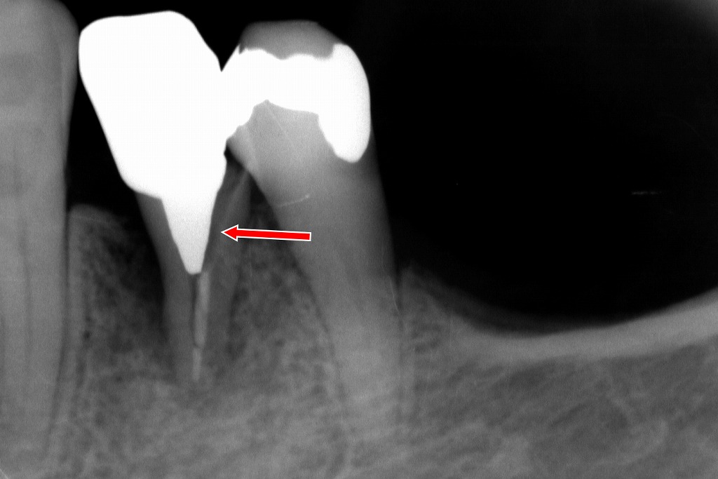 赤矢印部に縦方向の透過像が確認され、歯根破折が強く疑われる所見です。メタルコアにより応力が集中し破折が生じた典型例です。