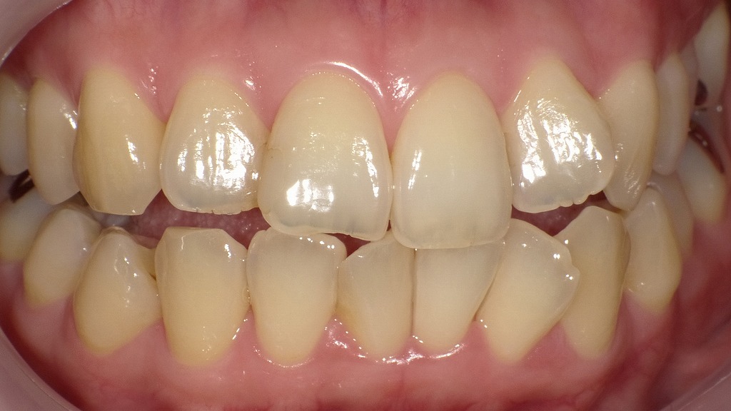 Before（ホワイトニング前）