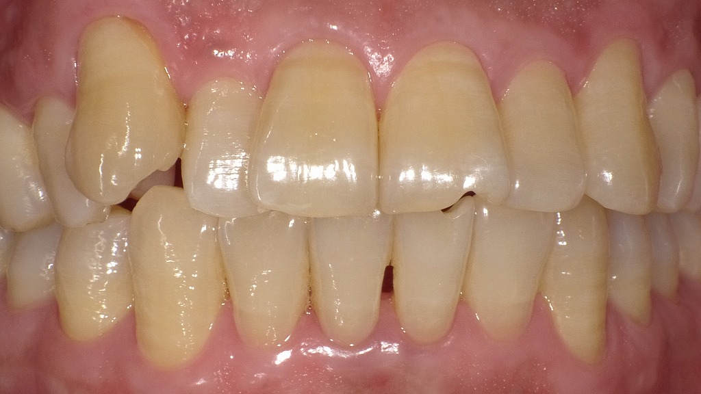 Before：黄ばみが気になる状態