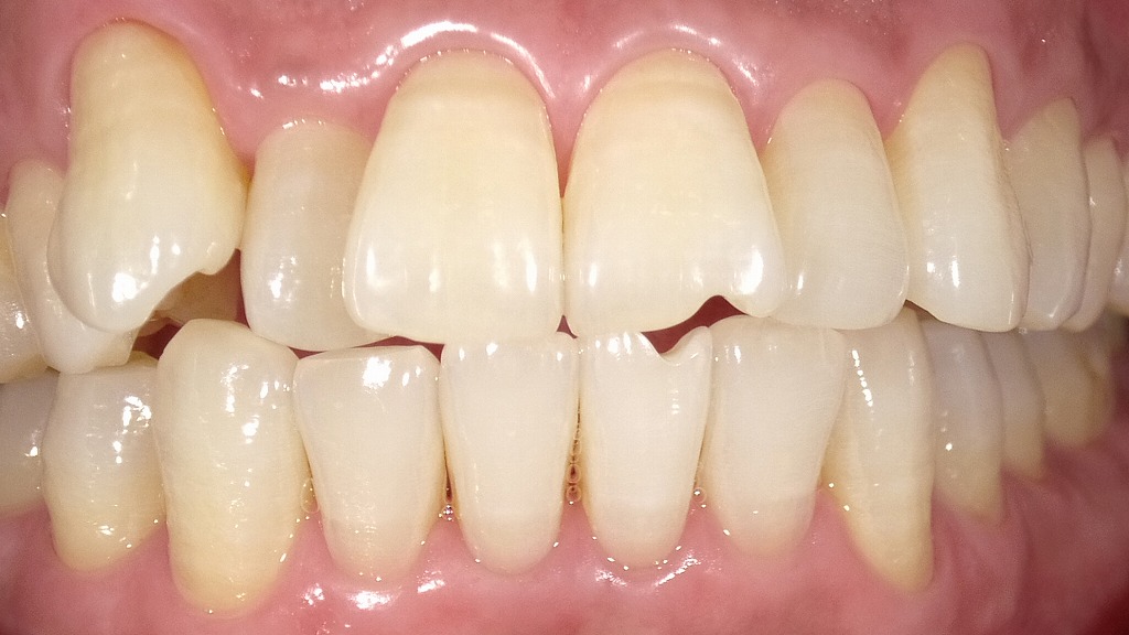 After：自然で明るい白さへトーンアップ