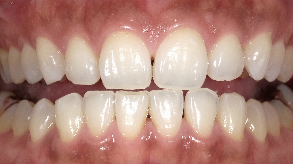 2枚目:2週間のホームホワイトニング後