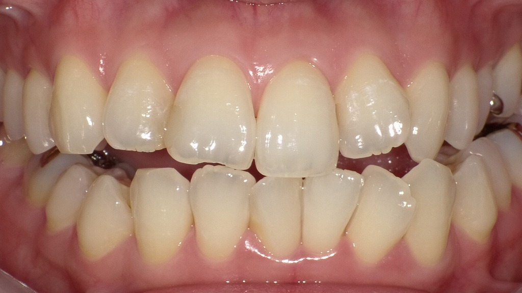 After（ホワイトニング後）