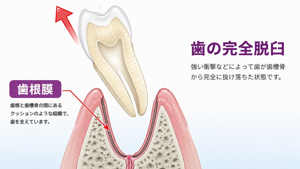 歯の完全脱臼