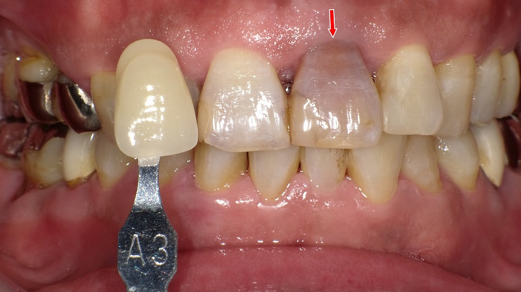 矢印の歯は神経が死んだことで内部が変色し、周囲の健康な歯（シェードA3）と比べて明らかに暗く見えています。外傷や根のトラブルで起こる典型的な失活歯の色調変化です。