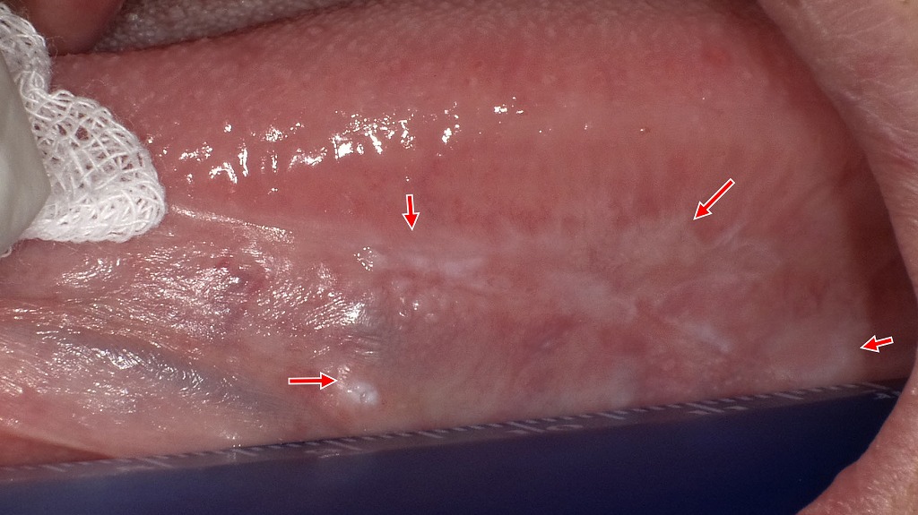 舌側面に認められた口腔扁平苔癬（レース状白斑）