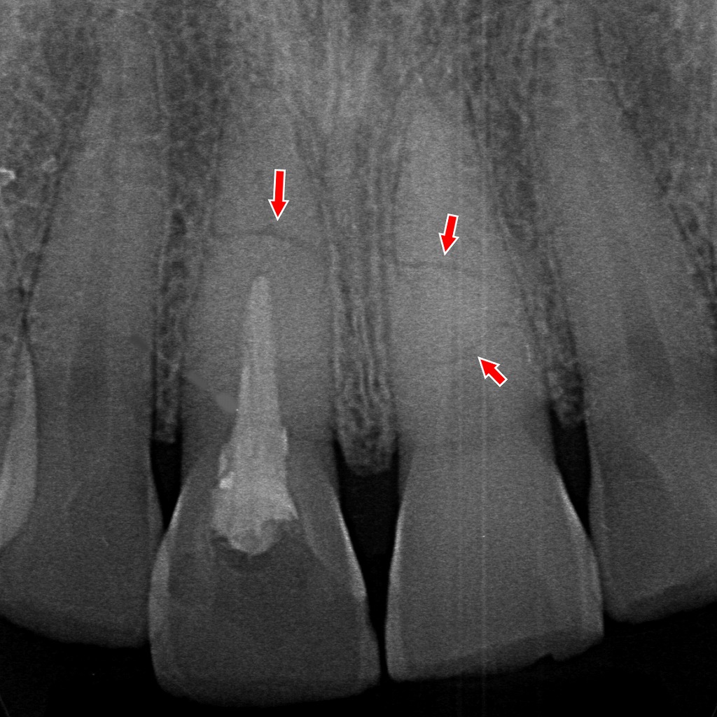 赤矢印の部分に外傷による横方向の歯根破折が確認され、保存が困難な状態です。