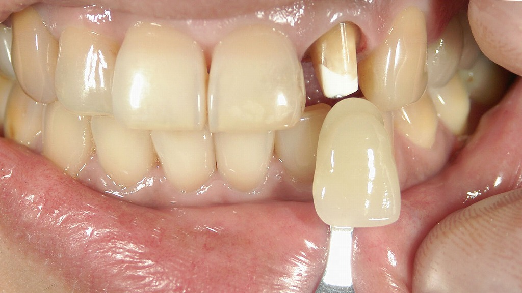 オールセラミック治療の流れ｜ファイバーコア・形成・印象採得・色合わせまでの重要ステップ