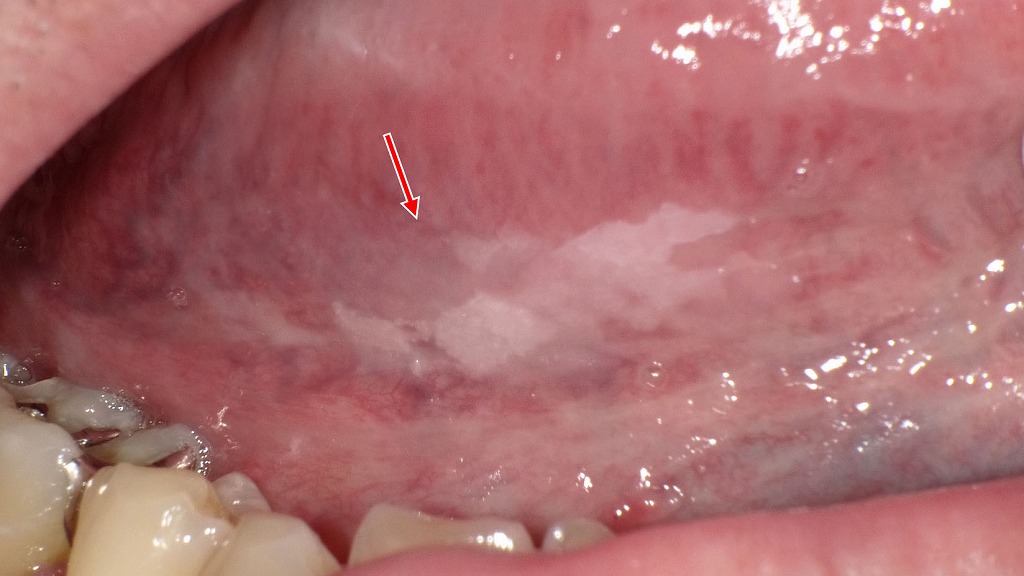 舌の裏に出来た白板症