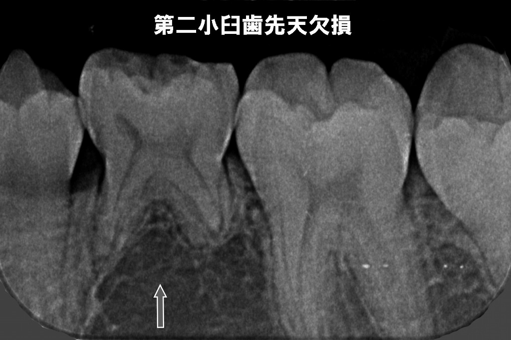 第二小臼歯の先天欠損