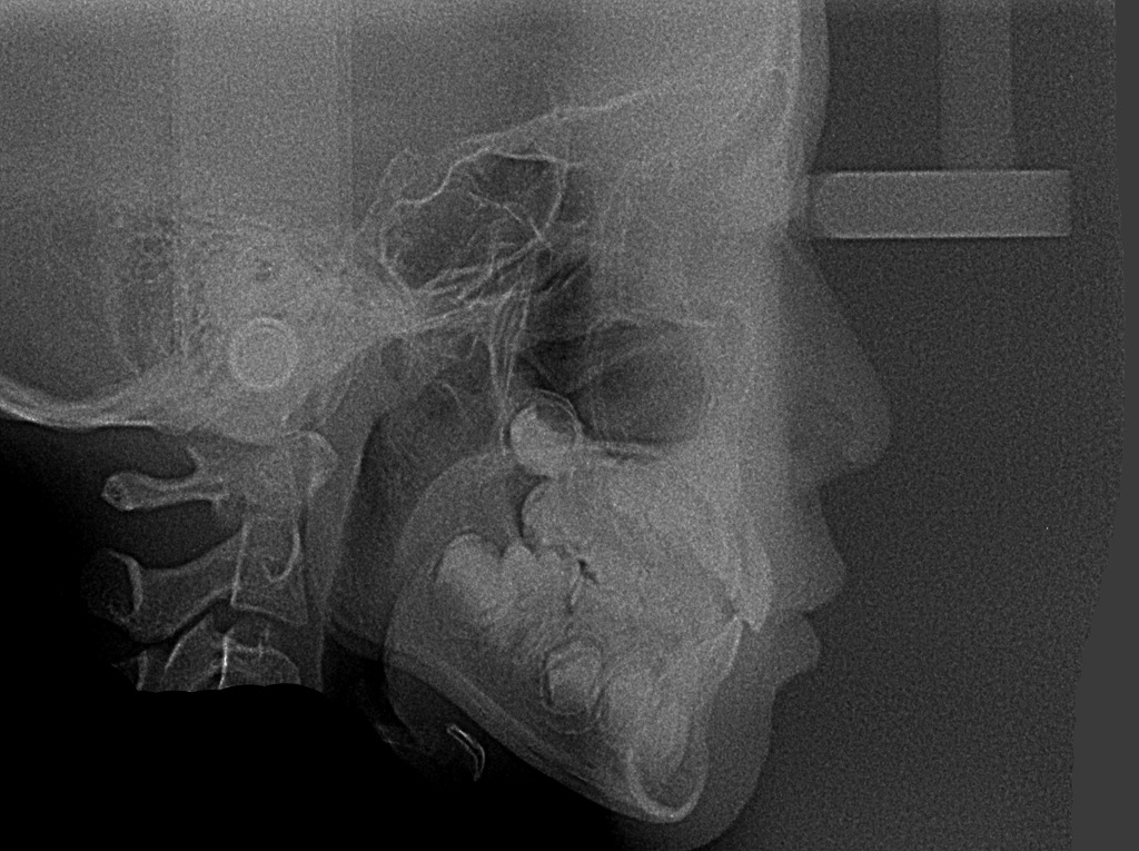 頭部X線規格写真（セファログラム：cephalogram）