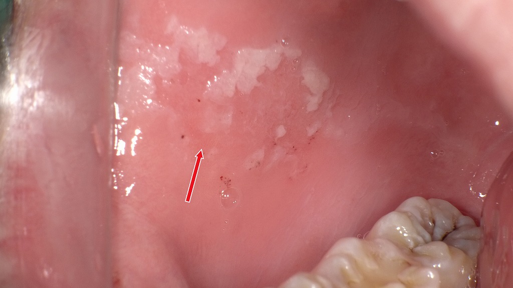 擦過しても残る白斑:白板症を疑う頬粘膜病変