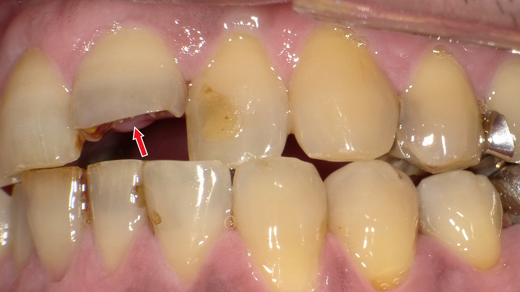 歯冠破折：神経まで露出なし