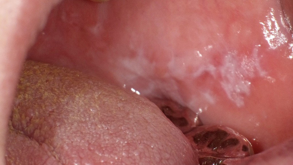 頬粘膜にレース状・網目状の白色病変（ウィッカム線条）を認める口腔扁平苔癬の一例。