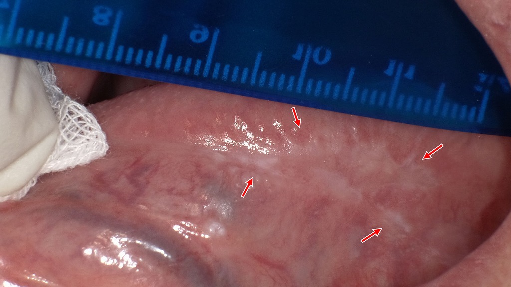 舌側面にみられる口腔扁平苔癬