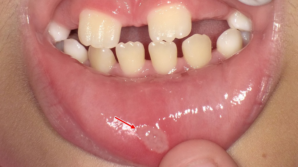 子どもに多い口内炎（アフタ性口内炎）