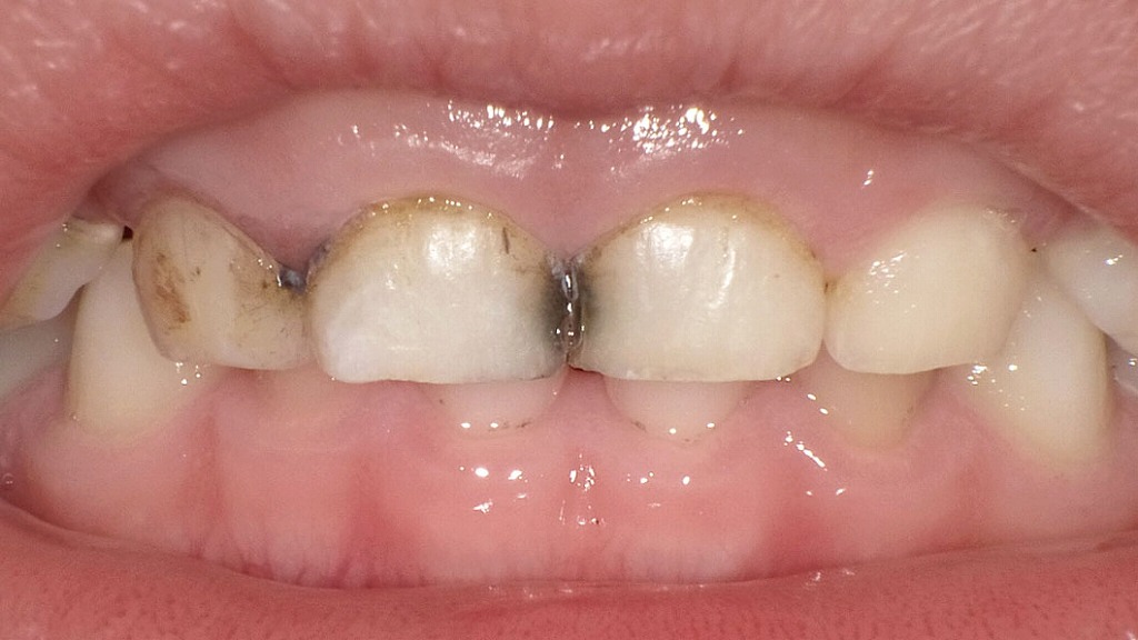 乳歯の虫歯にサホライド塗布