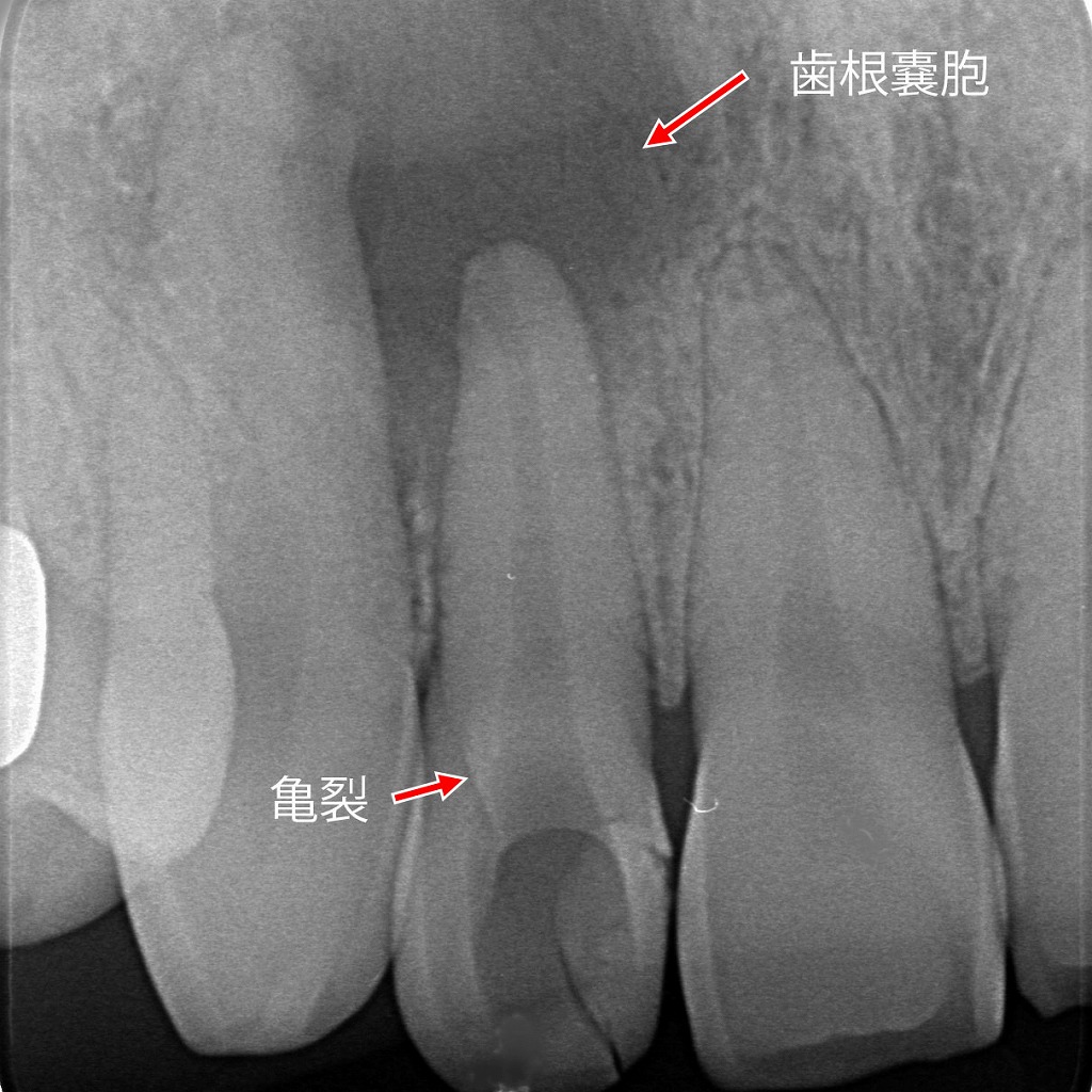 歯根まで及ぶ深い亀裂と歯根嚢胞 ― 保存が困難と判断された症例
