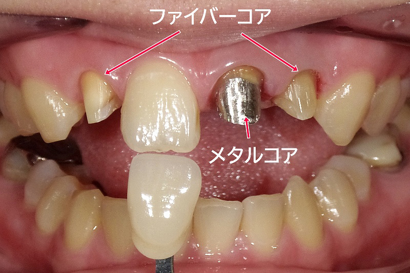 複数歯でファイバーコアと併用