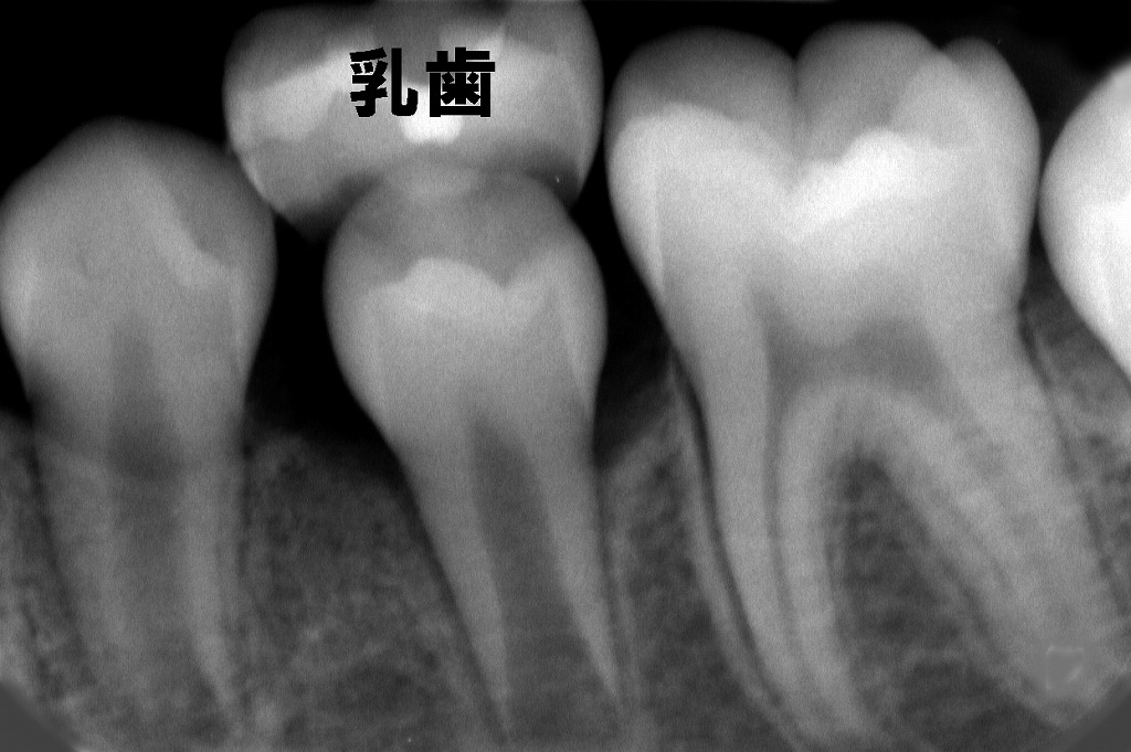 乳歯が自然脱落するケース