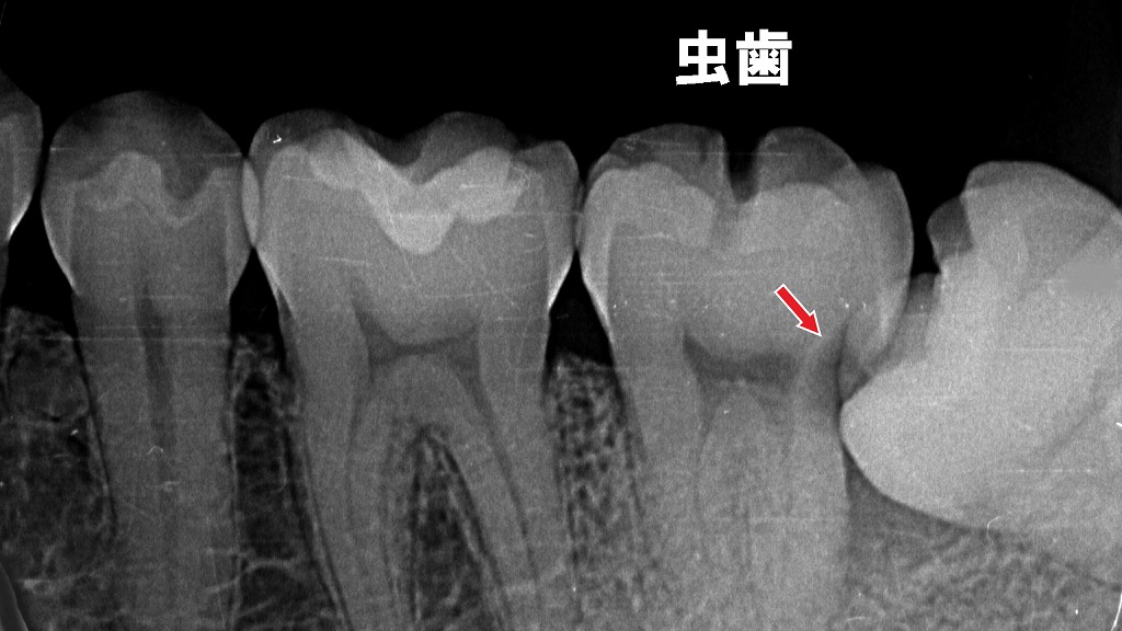押されてできた虫歯も、噛んだ時の痛みの原因に。