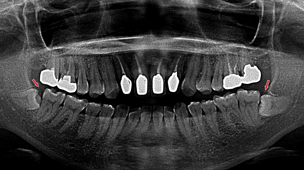 斜めに埋まった親知らずが炎症を起こし、膿が出る原因となる「智歯周囲炎」を示したX線画像です。