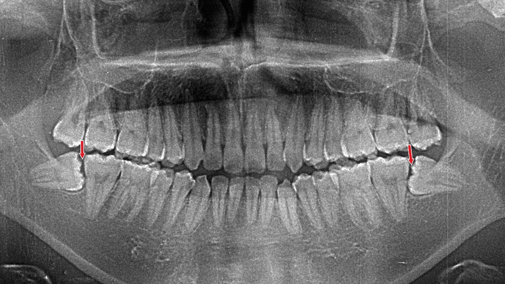 横向きの親知らずが炎症を起こし、痛みと腫れで口が開きにくくなる「開口障害」の原因となる状態を示す画像です。