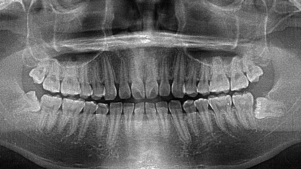 口腔全体を一枚で確認できる「パノラマレントゲン」の画像です。歯列や顎の状態を総合的に診査できます。