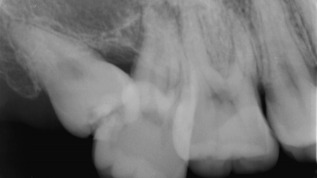 歯や歯根の状態を詳しく確認できる「デンタルレントゲン（口内法）」の画像です。