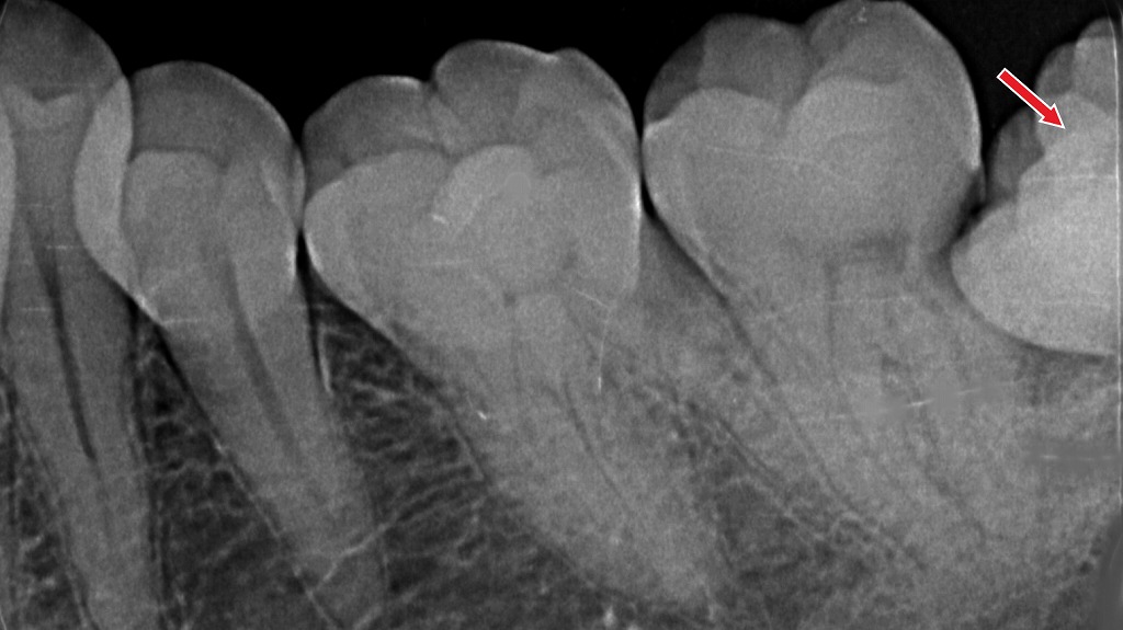 ワンタフトブラシなら届く親知らずの隙間。普通の歯ブラシでは磨き残しやすい部分をしっかりケアできます。