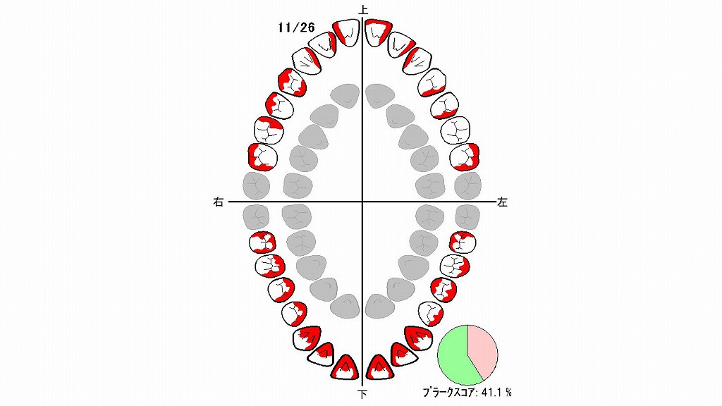 虫歯を防ぐためのプラークスコアによる評価