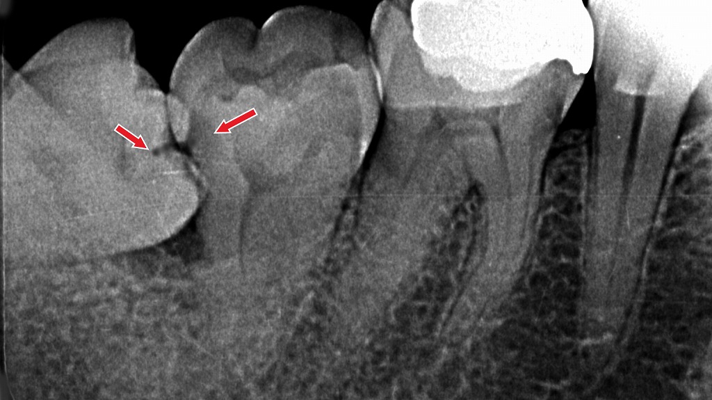 斜めに生えた親知らずが汚れをためやすく、親知らずと7番の両方に虫歯が発生しています。