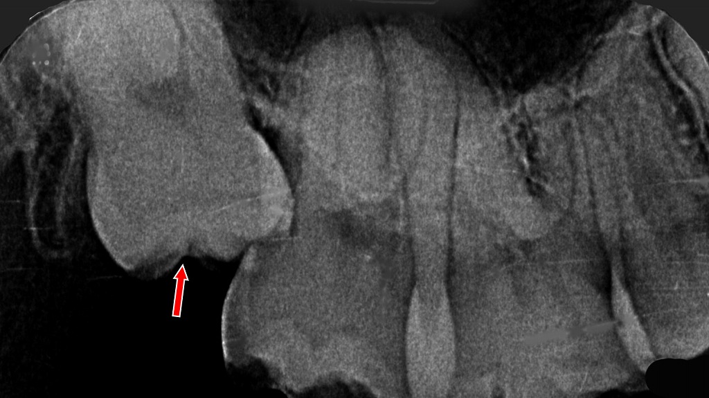 親知らずが前の歯を押し込み、歯が“浮いたように”感じる原因になることがあります。