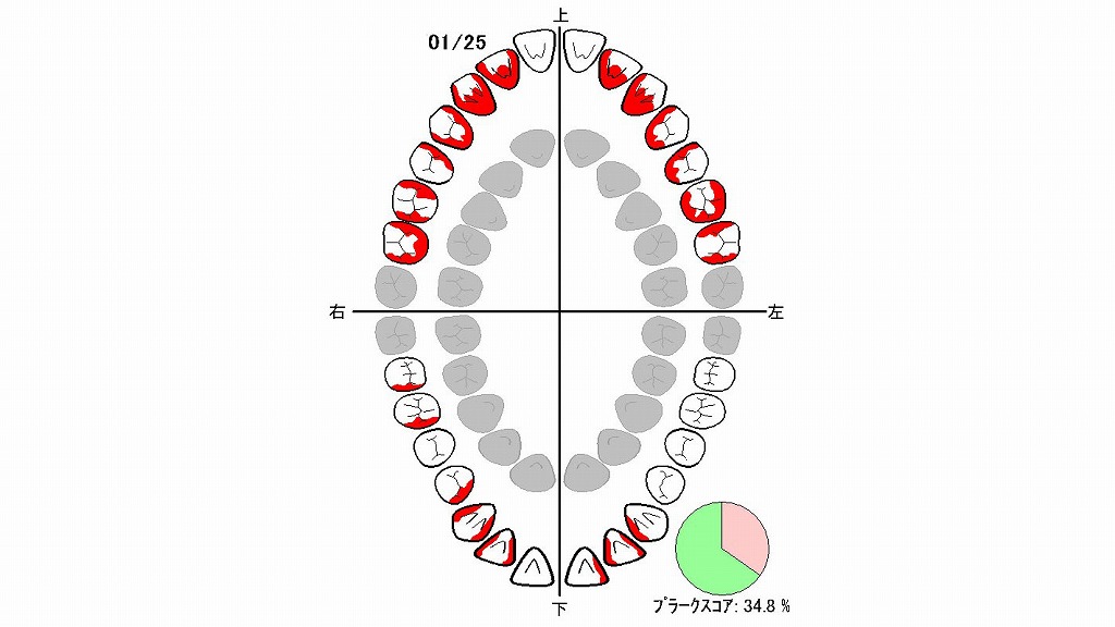 歯磨き指導とプラークスコア