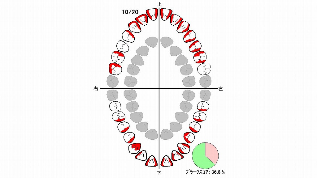 プラークスコア