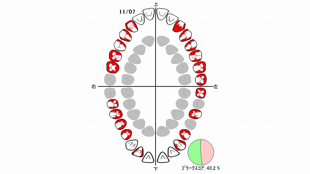染め出し検査で確認する歯垢の付着状態