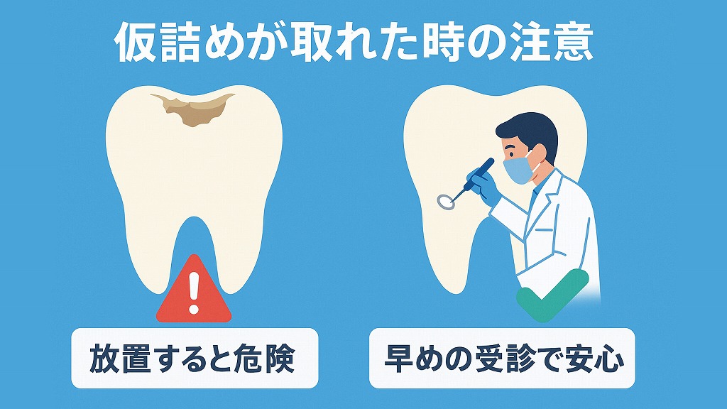 仮詰めが取れてしまったときの注意