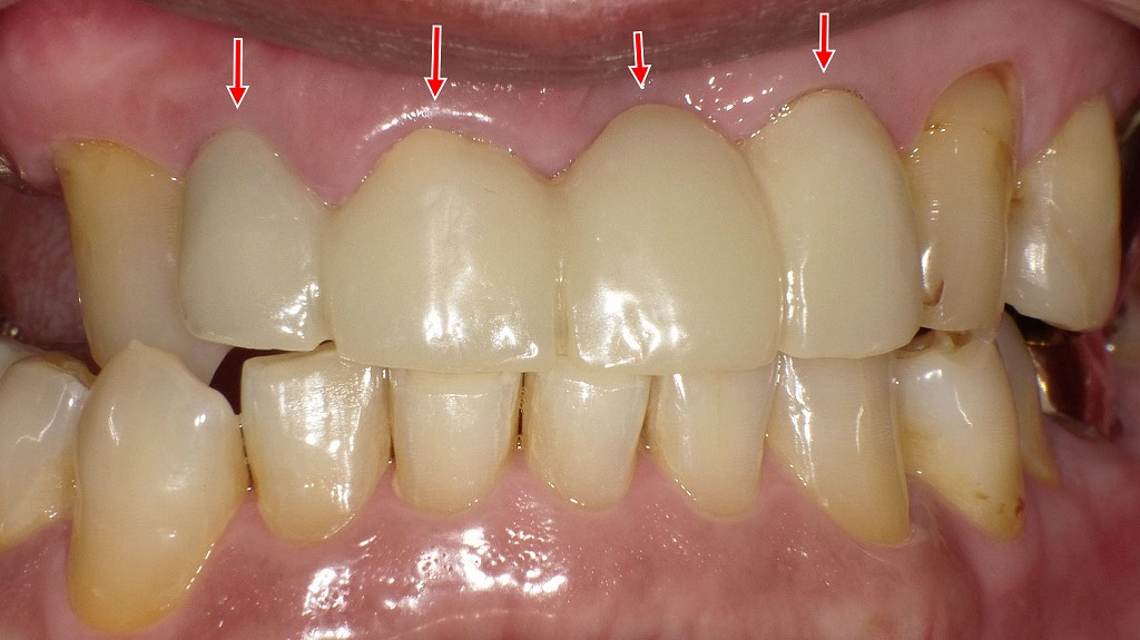 上顎左右2番～2番に仮歯のブリッジを装着
