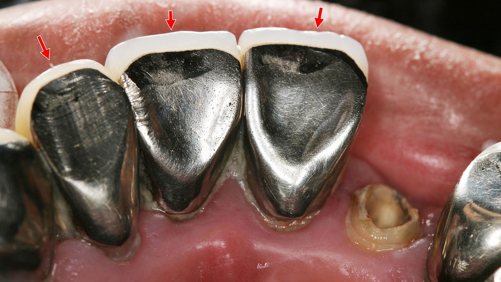 硬質レジン前装冠：裏側
