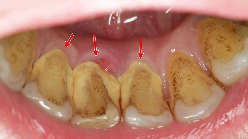 歯石と歯肉炎は静かに進行します