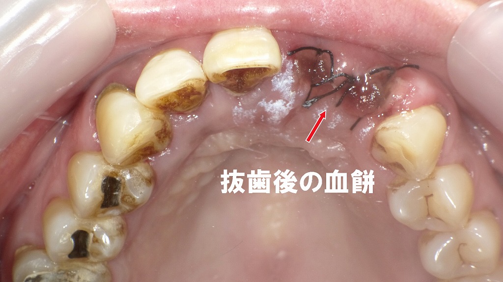 抜歯後の正常な治癒経過：血餅と縫合の状態
