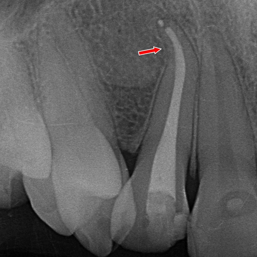 上顎2番にみられる“例外的に複雑な根管形態”