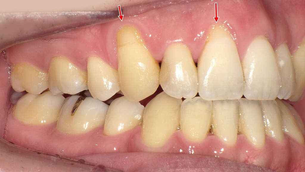 象牙質が露出（歯根露出）