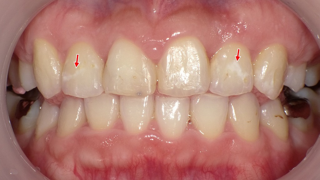 ホワイトスポットが目立つ前歯 ― ホワイトニング・アイコン治療前の状態