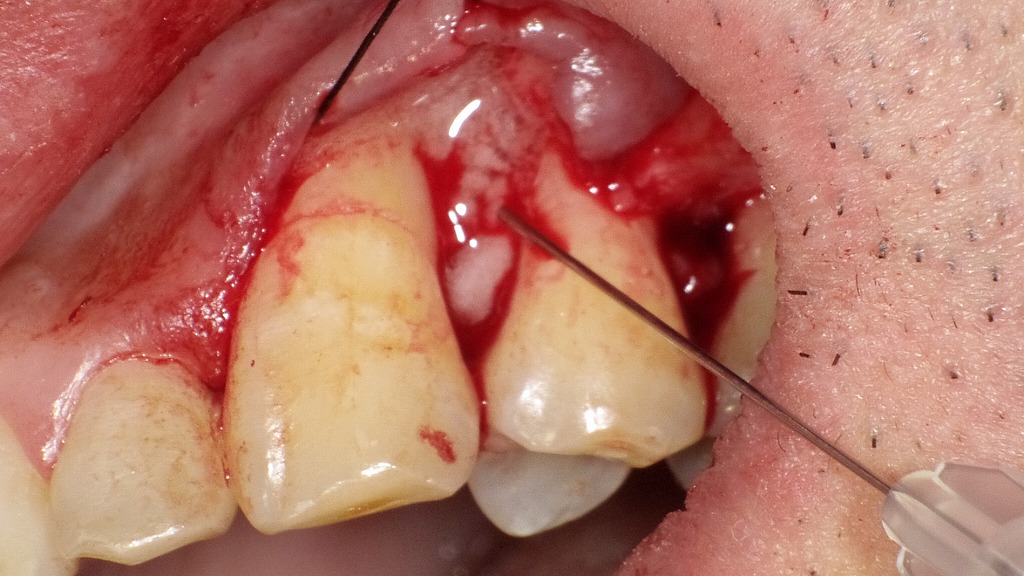 上顎犬歯(3番)遠心部の垂直性骨欠損部に対してリグロス®(歯周組織再生用材料)を填入