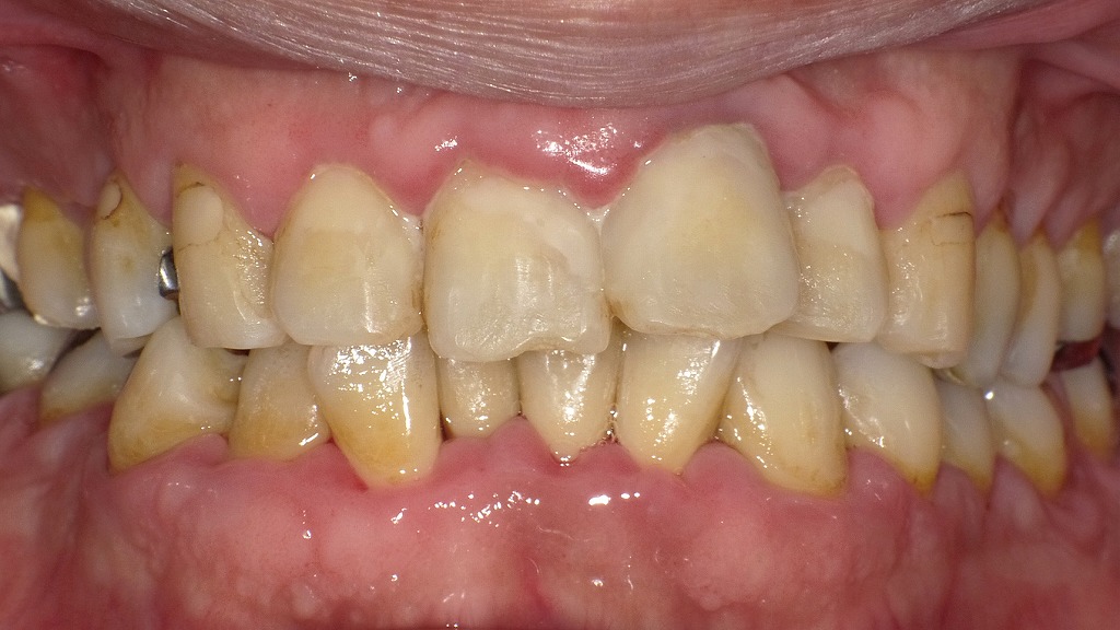 中等度歯周病：正面