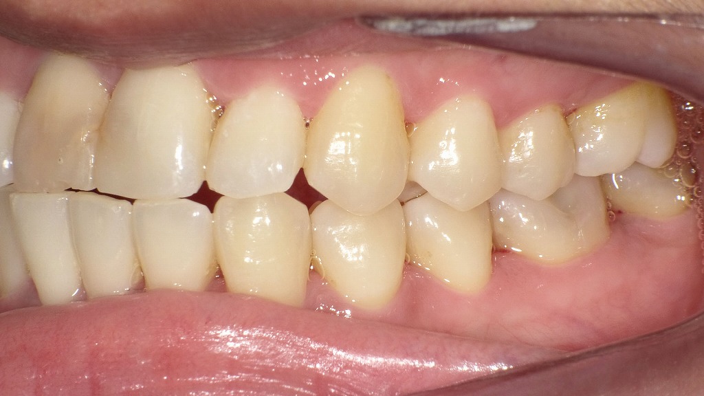 歯周病治療後の変化|歯石取り・SRP(スケーリング・ルートプレーニング)後の歯ぐきの状態